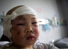 4岁女童被自家母猪咬伤 2万医疗费难住家人
