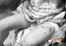 海南5岁女童被虐骨折处女膜破裂 警方通缉施虐人